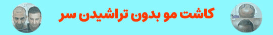 کاشت مو