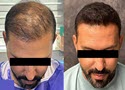 ارزان ترین قیمت عمل چشم با امکان پرداخت اقساطی دکترتو